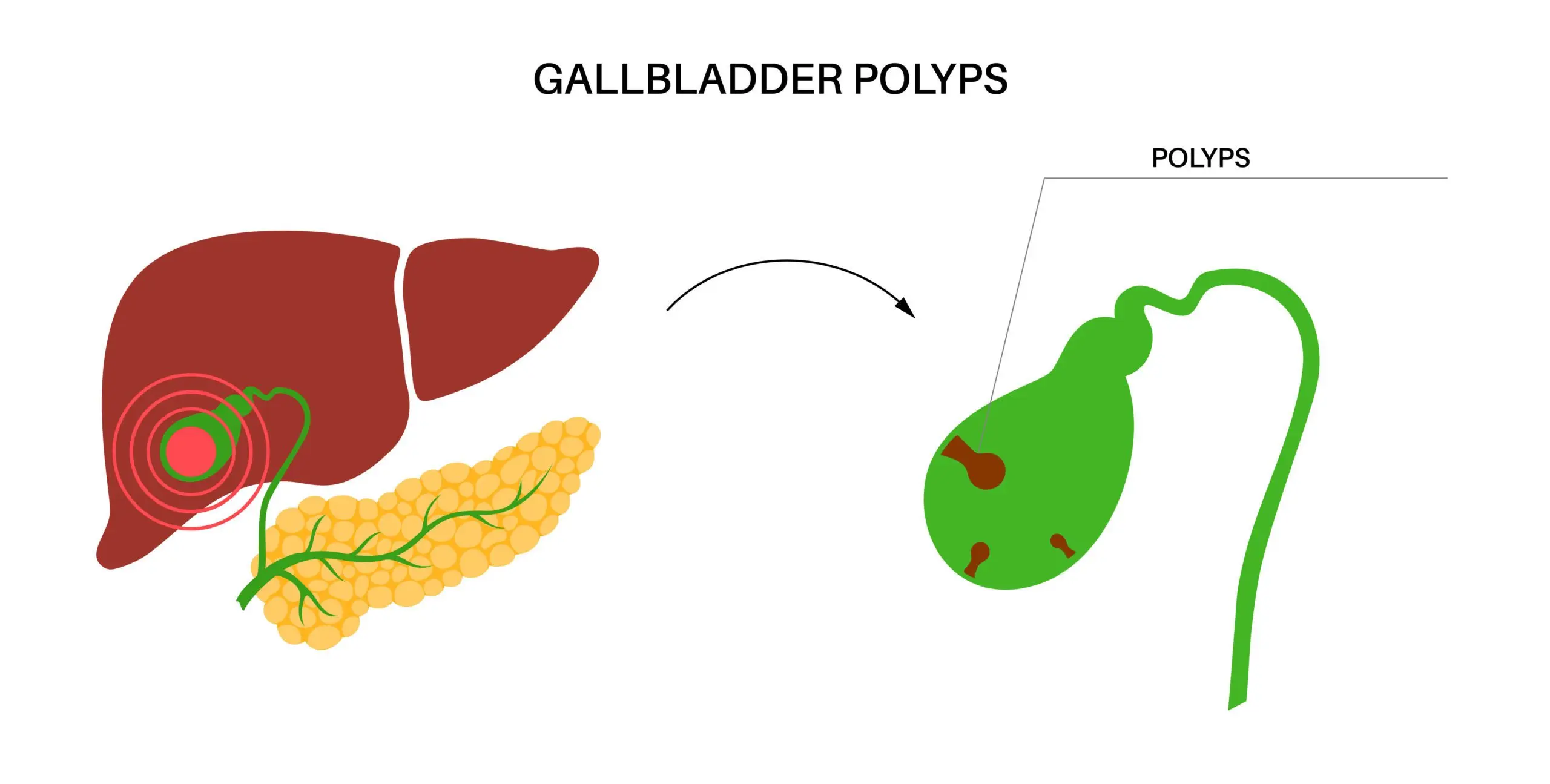 gallbldder-scaled